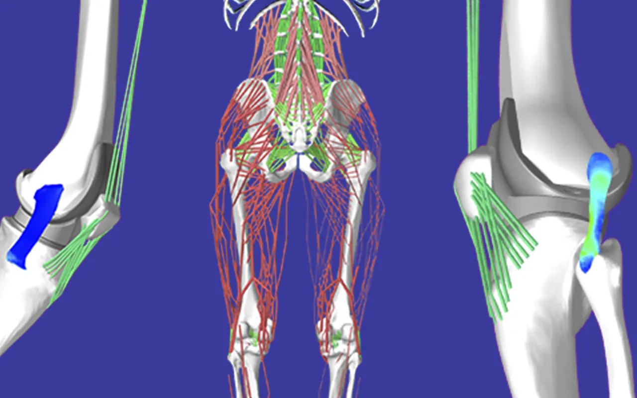 Pose de prothèses de genoux en précision 4D