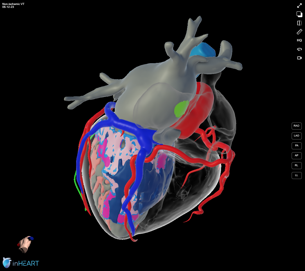 inHEART : levée de fonds au rythme des battements 