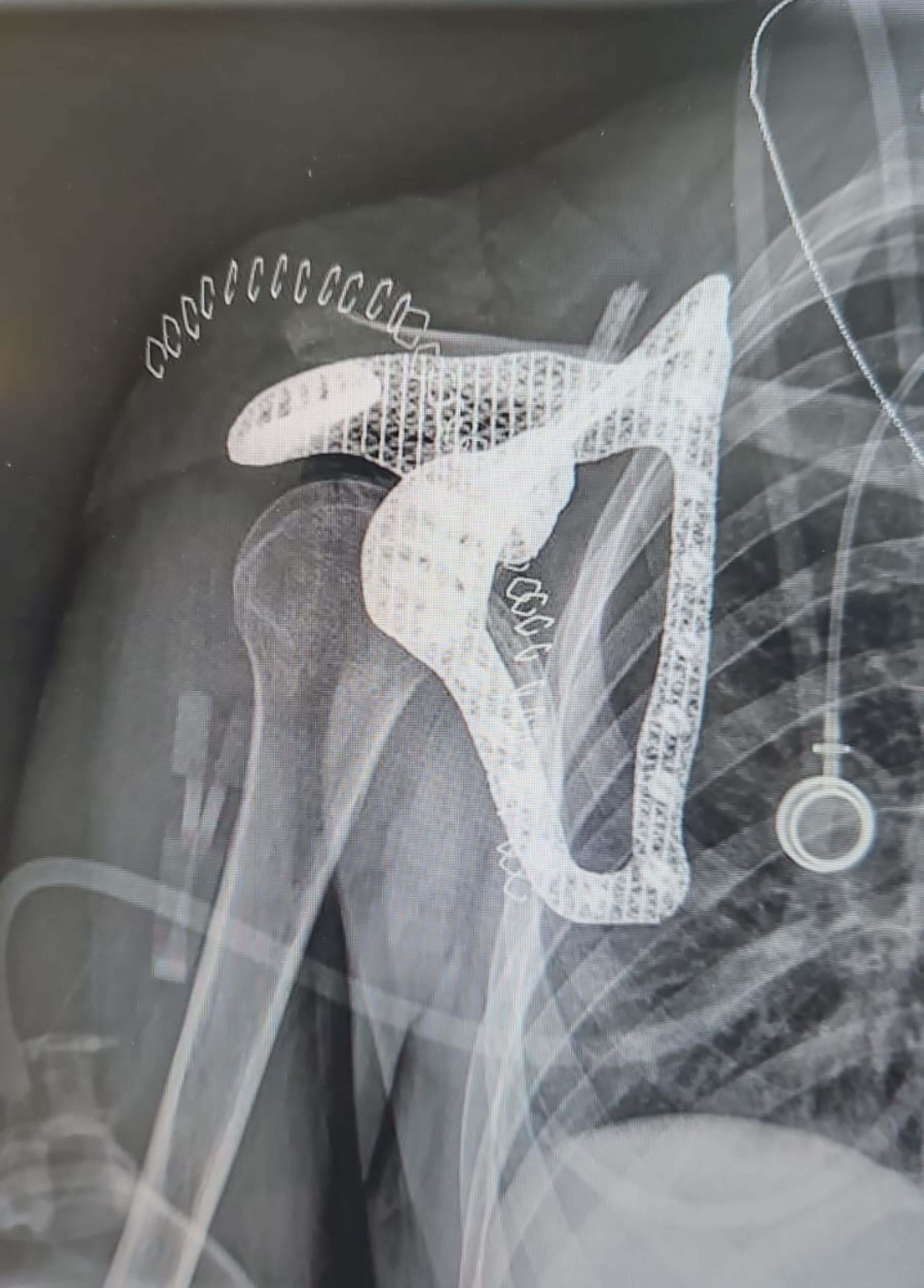 Créer des implants sur mesure grâce au jumeau numérique